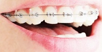 <b>Скидка до 50%.</b> Установка брекет-системы в стоматологии Avanta Dental Professional Clinic