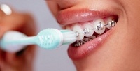 <b>Скидка до 71%.</b> Установка брекет-системы в стоматологической клинике Golden Dent Clinic