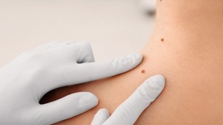 <b>Скидка до 80%.</b> Удаление новообразований в медицинском центре «Здоровье»