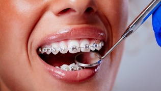 <b>Скидка до 80%.</b> Установка брекетов, диагностика и полировка зубов, установка зубного имплантата в стоматологической клинике «Дентал Студио»