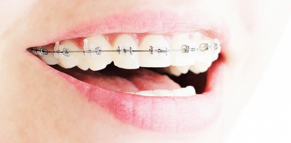 Установка брекет-системы в стоматологии Avanta Dental Professional Clinic