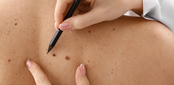 Удаление новообразований в «ЛДЦ»