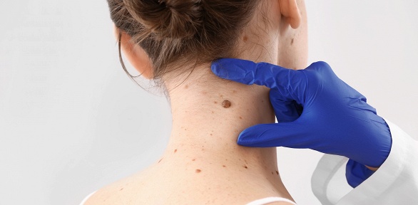 Удаление новообразований в медицинском центре My Skin Lab