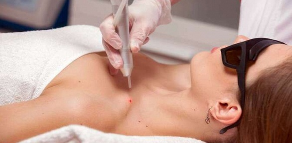 Удаление новообразований в клинике Lumerika