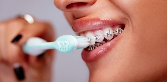 Установка брекет-системы в стоматологической клинике Golden Dent Clinic