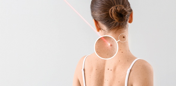 Удаление новообразований в учебно-косметическом центре Cosmo Profi