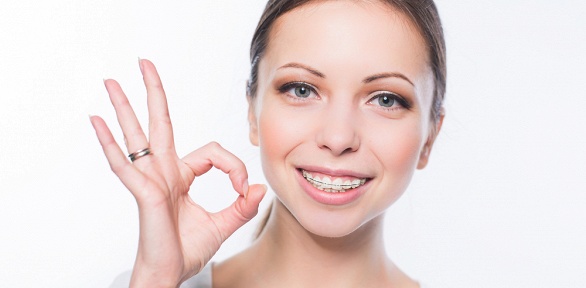 Установка брекет-системы на одну или две челюсти в стоматологии «Аврора»