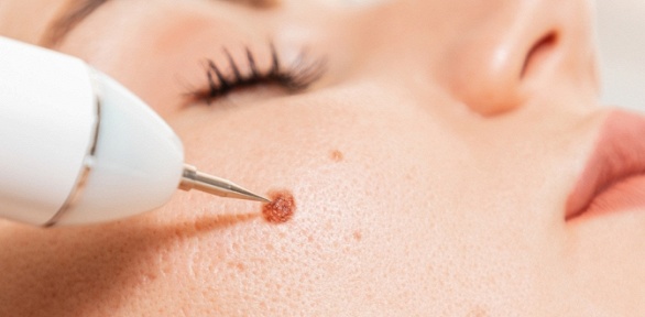 <b>Скидка до 53%.</b> Удаление новообразований в клинике косметологии Lancon Cliniс